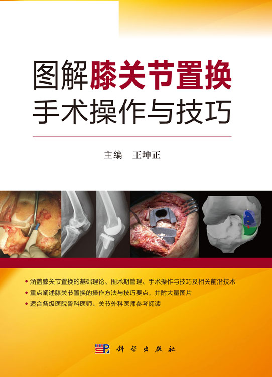 图解膝关节置换手术操作与技巧
