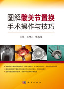 图解髋关节置换手术操作与技巧