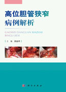 高位胆管狭窄病例解析