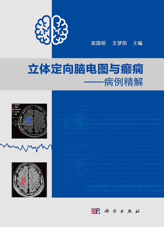 立体定向脑电图与癫痫：病例精解