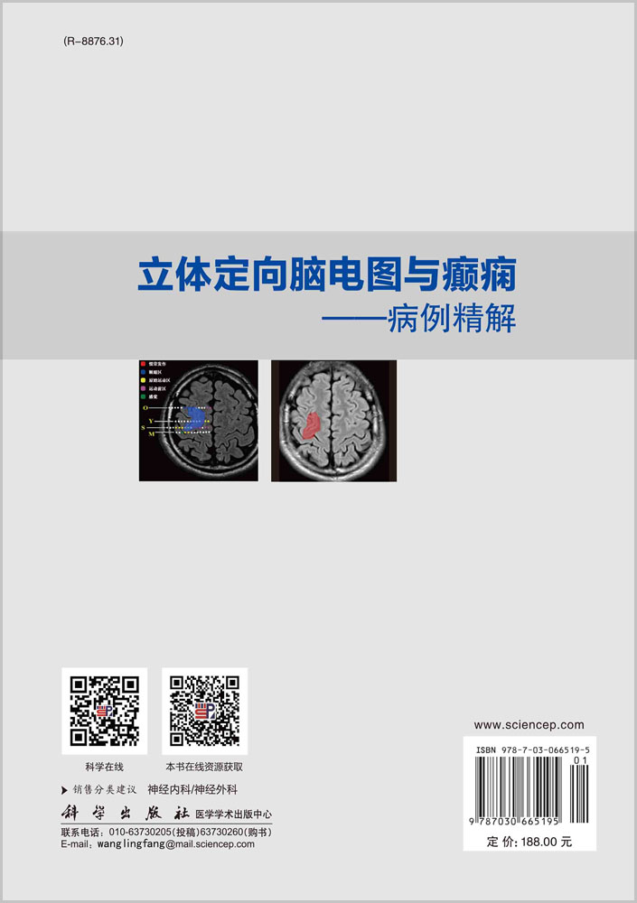立体定向脑电图与癫痫：病例精解