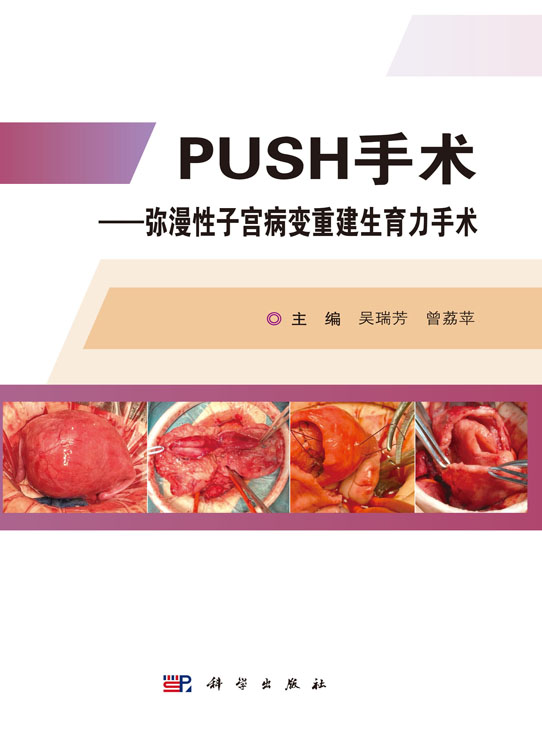 PUSH手术——弥漫性子宫病变重建生育力手术
