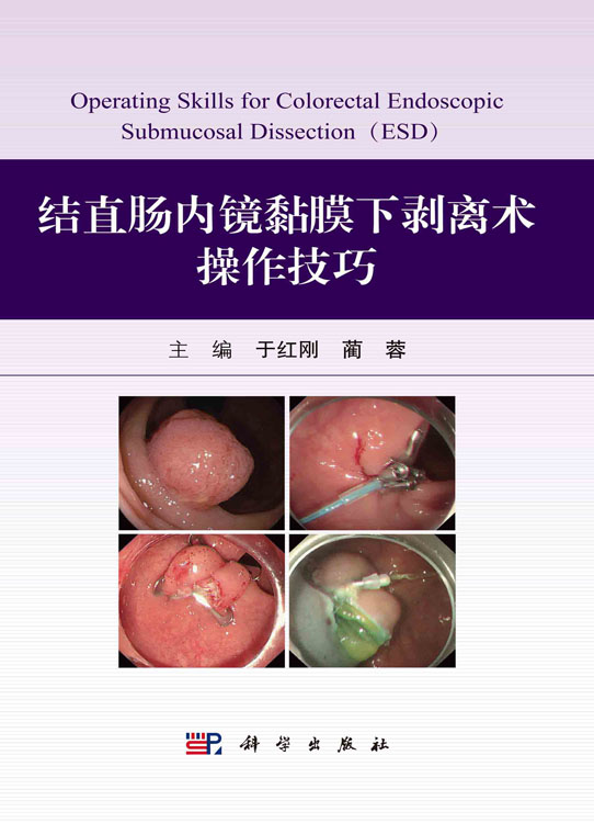 结直肠内镜黏膜下剥离术操作技巧