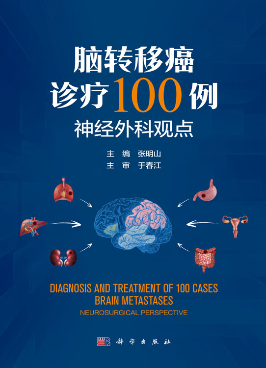 脑转移癌诊疗100例——神经外科观点