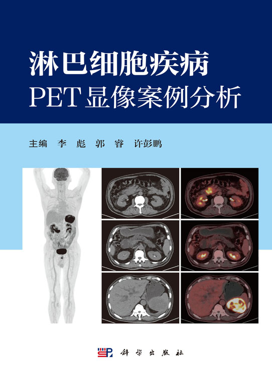 淋巴细胞疾病PET显像案例分析