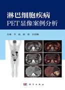 淋巴细胞疾病PET显像案例分析
